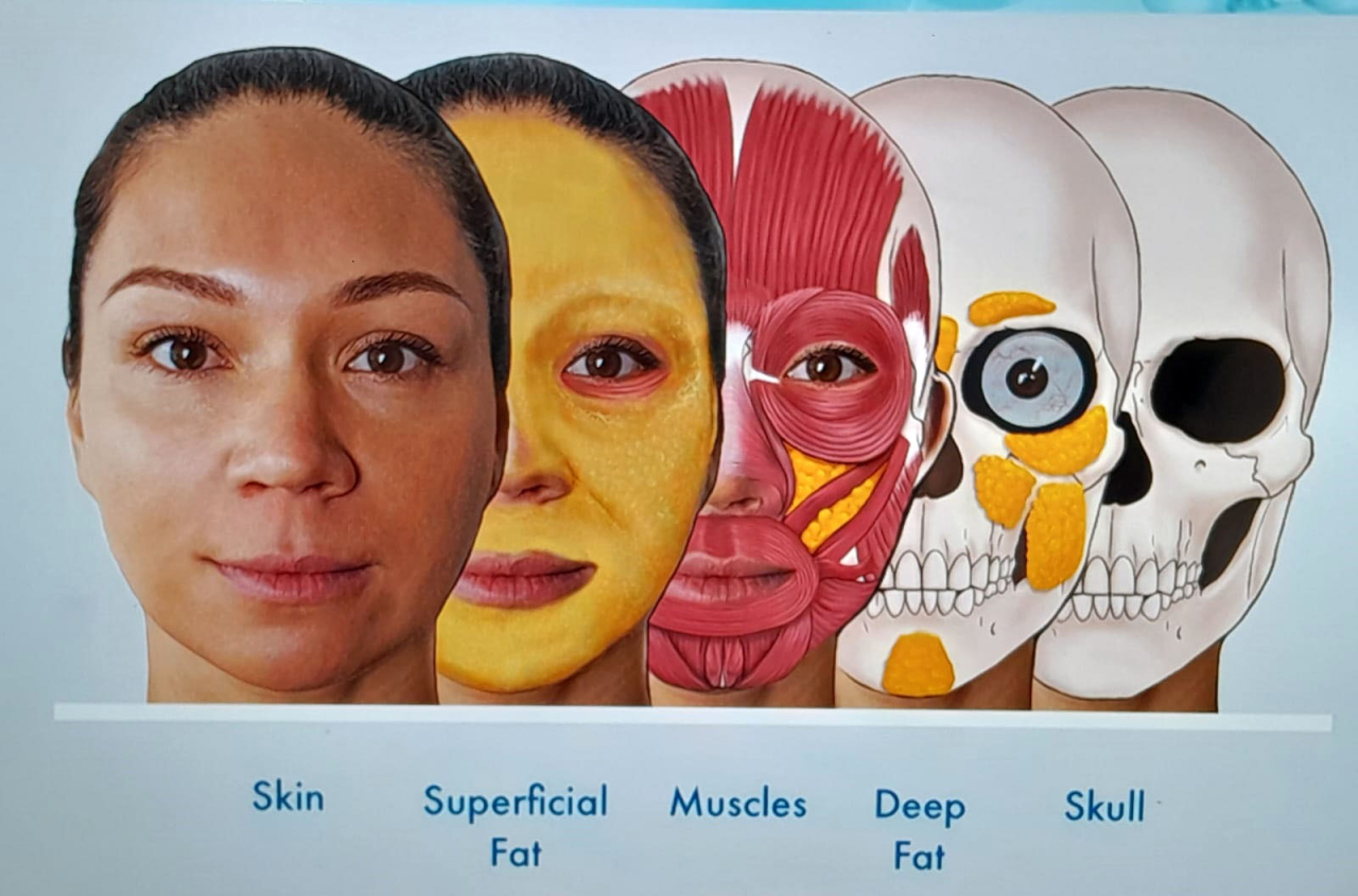 Filler merupakan salah satu pilihan aesthetic treatment yang dapat membantu memperbaiki dan memperindah penampilan bentuk wajah. Foto/Alim Perdana